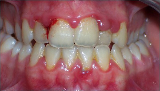 Gingivitis: ¿Cómo Detectarla y Detener su Avance? Guía Completa de Cuidado Oral