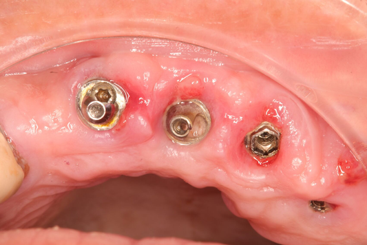 Periimplantitis: La Guía Definitiva para Entender y Combatir esta Enfermedad de los Implantes Dentales