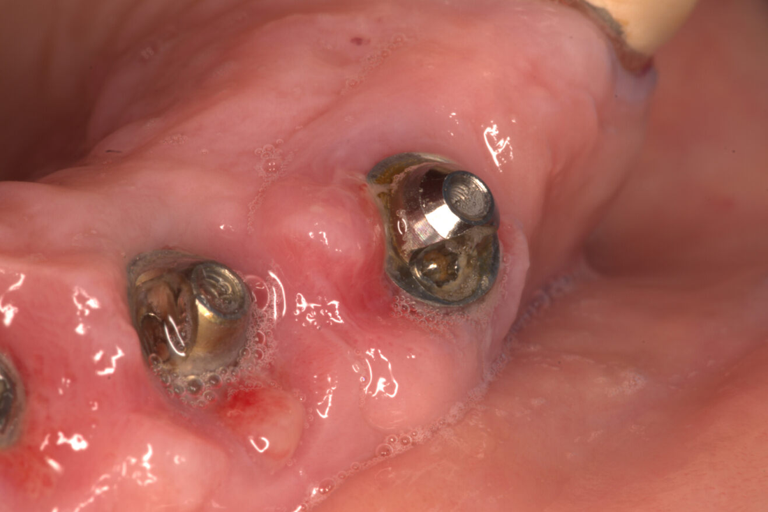 ¿Qué es la Mucositis Periimplantaria y Cómo Afecta a tus Implantes Dentales? Guía Completa